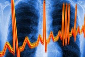 Rythme cardiaque contre l'ostéochondrose