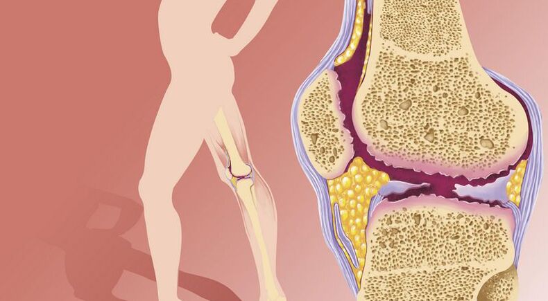 Le surpoids conduit à l'arthrose