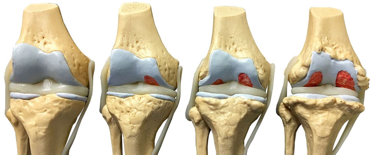 Stades d'arthrose