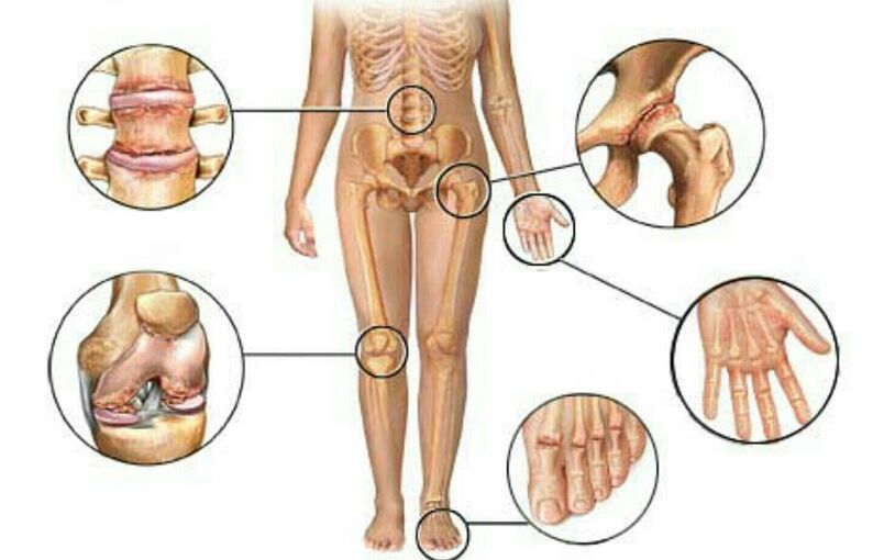 Types et degrés d'arthrose